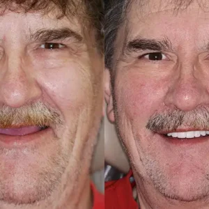 HZA™ --🦷Advanced Customized Full Denture Set🦷 (⏰Limited time discount last 30 minutes⏰)