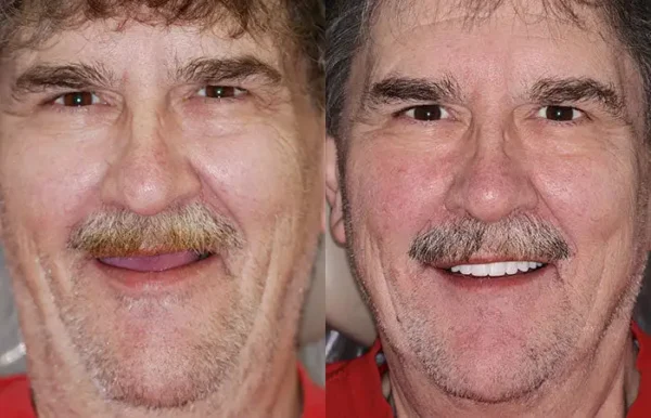 HZA™ --🦷Advanced Customized Full Denture Set🦷 (⏰Limited time discount last 30 minutes⏰)