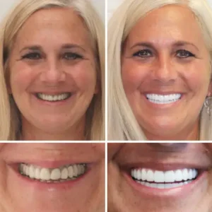HZA™ --🦷Advanced Customized Full Denture Set🦷 (⏰Limited time discount last 30 minutes⏰)