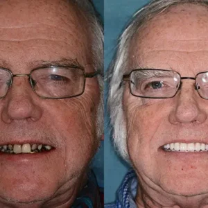 HZA™ --🦷Made in Germany Advanced Customized Full Denture Set