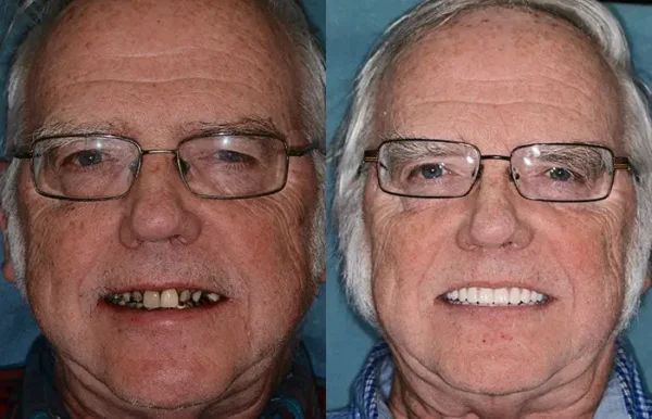 HZA™ --🦷Made in Germany Advanced Customized Full Denture Set