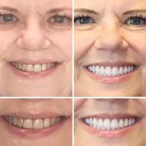 HZA™ --🦷Made in Germany Advanced Customized Full Denture Set