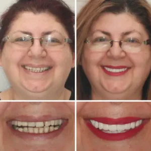 HZA™ --🦷Made in Germany Advanced Customized Full Denture Set